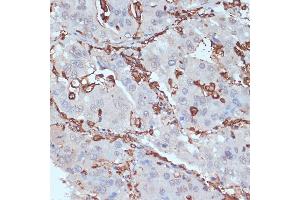 Immunohistochemistry of paraffin-embedded human liver cancer using HLA-DRA antibody (ABIN6131757, ABIN6141827, ABIN6141829 and ABIN6215475) at dilution of 1:100 (40x lens).