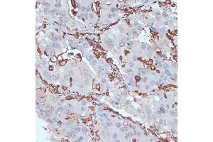Immunohistochemistry of paraffin-embedded human liver cancer using HLA-DRA antibody (ABIN6131757, ABIN6141827, ABIN6141829 and ABIN6215475) at dilution of 1:100 (40x lens). (HLA-DRA anticorps  (AA 26-216))