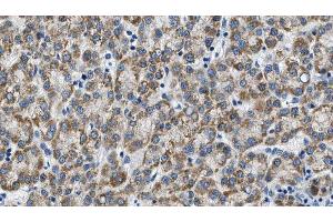 ABIN6274603 at 1/100 staining Human liver cancer tissue by IHC-P.
