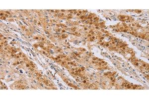 Immunohistochemistry of paraffin-embedded Human gastic cancer using CDC46 Polyclonal Antibody at dilution of 1:40 (MCM5 anticorps)