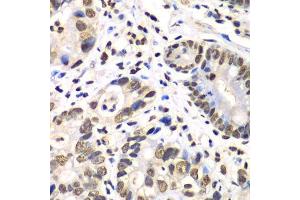 Immunohistochemistry of paraffin-embedded human gastric cancer using RBBP7 antibody. (RBBP7 anticorps  (AA 1-230))