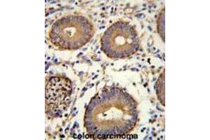 Immunohistochemistry (IHC) image for anti-Carcinoembryonic Antigen Gene Family (CEA) antibody (ABIN3002653) (CEA anticorps)