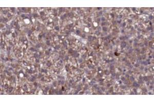 ABIN6276764 at 1/100 staining Human liver cancer tissue by IHC-P.