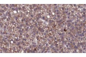 ABIN6276764 at 1/100 staining Human liver cancer tissue by IHC-P.