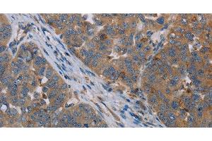 Immunohistochemistry of paraffin-embedded Human ovarian cancer tissue using OTOR Polyclonal Antibody at dilution 1:30