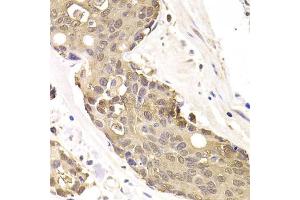 Immunohistochemistry of paraffin-embedded human colon carcinoma using FKBP4 Antibody (ABIN5973289) at dilution of 1/200 (40x lens). (FKBP4 anticorps)