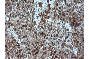 Immunohistochemical staining of paraffin-embedded Carcinoma of Human lung tissue using anti-ADH7 mouse monoclonal antibody. (ADH7 anticorps)