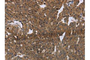 The image on the left is immunohistochemistry of paraffin-embedded Human ovarian cancer tissue using ABIN7191253(LAIR2 Antibody) at dilution 1/20, on the right is treated with synthetic peptide.
