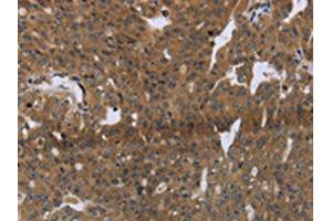 The image on the left is immunohistochemistry of paraffin-embedded Human ovarian cancer tissue using ABIN7191253(LAIR2 Antibody) at dilution 1/20, on the right is treated with synthetic peptide. (LAIR2 anticorps)