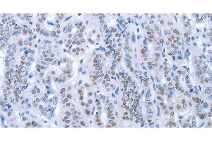 Immunohistochemistry of paraffin-embedded Human thyroid cancer using PAX8 Polyclonal Antibody at dilution of 1:35 (PAX8 anticorps)