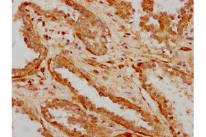 IHC image of ABIN7156114 diluted at 1:600 and staining in paraffin-embedded human prostate cancer performed on a Leica BondTM system. (ILDR1 anticorps  (AA 393-541))