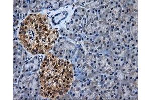 Immunohistochemical staining of paraffin-embedded Adenocarcinoma of colon tissue using anti-HSD17B10mouse monoclonal antibody. (HSD17B10 anticorps)