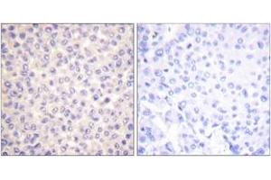 Immunohistochemistry analysis of paraffin-embedded human breast carcinoma, using FADD (Phospho-Ser194) Antibody. (FADD anticorps  (pSer194))