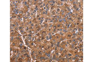 Immunohistochemistry of Human colon cancer using ELP2 Polyclonal Antibody at dilution of 1:40 (ELP2 anticorps)
