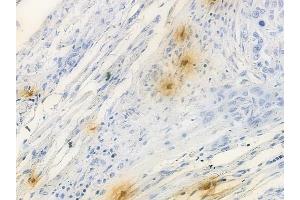 ABIN6257001 and ABIN6274697 at 1/100 staining human tongue carcinoma by IHC-P. (PHLDA1 anticorps  (N-Term))