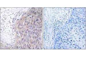 Immunohistochemistry analysis of paraffin-embedded human cervix carcinoma tissue, using POLG2 Antibody. (POLG2 anticorps  (AA 291-340))