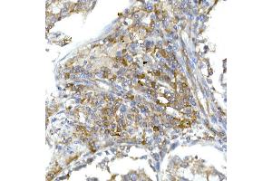 Immunohistochemistry of paraffin-embedded human lung cancer using RPL13 Rabbit mAb (ABIN7269993) at dilution of 1:50 (40x lens). (RPL13 anticorps)
