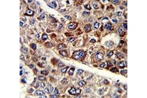 IHC analysis of FFPE human hepatocarcinoma with CD38 antibody
