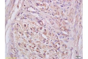 Formalin-fixed and paraffin embedded human cervical carcinoma labeled with Anti-NKG2C Polyclonal Antibody, Unconjugated (ABIN739950) at 1:200 followed by conjugation to the secondary antibody and DAB staining (KLRC2 anticorps)