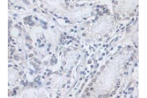 IHC-P analysis of Human Stomach Cancer Tissue, with DAB staining. (VCP anticorps  (AA 125-371))