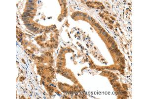 Immunohistochemistry of Human colon cancer using HTR3A Polyclonal Antibody at dilution of 1:50 (Serotonin Receptor 3A anticorps)