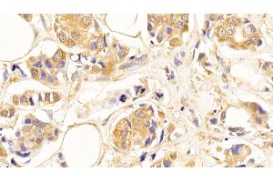 Detection of TUBb in Human Breast cancer Tissue using Anti-Tubulin Beta (TUBb) Monoclonal Antibody