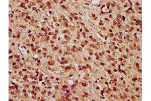 IHC image of ABIN7163751 diluted at 1:100 and staining in paraffin-embedded human glioma performed on a Leica BondTM system. (PARP3 anticorps  (AA 1-240))