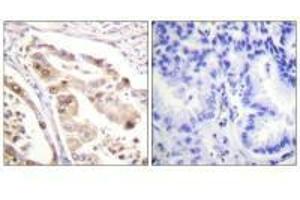 Immunohistochemistry analysis of paraffin-embedded human lung carcinoma tissue using RFA2 (Ab-21) antiobdy. (RPA2 anticorps  (Thr21))