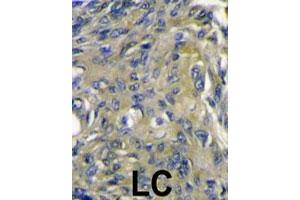 Formalin-fixed and paraffin-embedded human lung carcinoma reacted with FIGF polyclonal antibody  , which was peroxidase-conjugated to the secondary antibody, followed by DAB staining. (VEGFD anticorps  (C-Term))