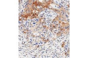 Immunohistochemical analysis of paraffin-embedded human breast carcinoma tissue using (ABIN1881847 and ABIN2838812) performed on the Leica® BOND RXm.