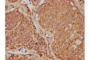 IHC image of ABIN7162214 diluted at 1:90 and staining in paraffin-embedded human liver cancer performed on a Leica BondTM system. (Oncostatin M anticorps  (AA 26-220))