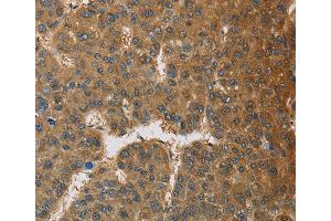 Immunohistochemistry of Human thyroid cancer using TNFRSF10D Polyclonal Antibody at dilution of 1:60 (DcR2 anticorps)