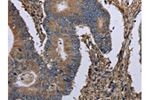 The image on the left is immunohistochemistry of paraffin-embedded Human colon cancer tissue using ABIN7130197(MCM3AP Antibody) at dilution 1/30, on the right is treated with fusion protein. (GANP anticorps)
