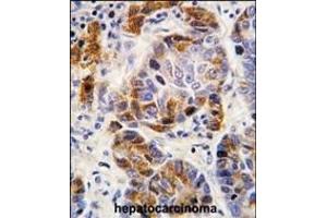 Formalin-fixed and paraffin-embedded human hepatocarcinoma tissue reacted with ALDH4A1 antibody (Center), which was peroxidase-conjugated to the secondary antibody, followed by DAB staining. (ALDH4A1 anticorps  (AA 288-314))