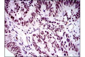 Immunohistochemical analysis of paraffin-embedded rectum cancer tissues using FOXP1 mouse mAb with DAB staining.