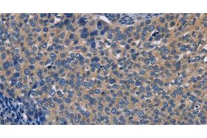 Immunohistochemistry of paraffin-embedded Human cervical cancer using SYT17 Polyclonal Antibody at dilution of 1:60