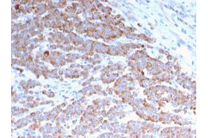 Formalin-fixed, paraffin-embedded human Colon Carcinoma stained with Cytokeratin 18 Mouse Monoclonal Antibody (rKRT18/1190). (Recombinant Cytokeratin 18 anticorps)