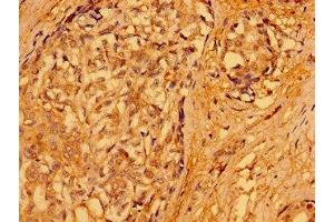 Immunohistochemistry of paraffin-embedded human breast cancer using ABIN7165690 at dilution of 1:100 (PACSIN3 anticorps  (AA 1-300))