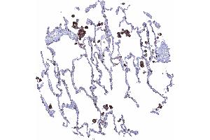 Lung Strong HLA DRB1 staining in alveolar macrophages HLA DRB1 immunohistochemistry