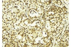 ABIN6269042 at 1/100 staining Human breast cancer tissue by IHC-P.