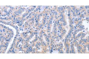Immunohistochemistry of paraffin-embedded Human thyroid cancer using B3GAT1 Polyclonal Antibody at dilution of 1:40 (CD57 anticorps)