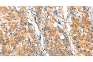 Immunohistochemistry of paraffin-embedded Human gasrtic cancer tissue using ST14 Polyclonal Antibody at dilution 1:70 (ST14 anticorps)