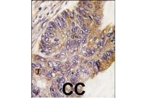 Formalin-fixed and paraffin-embedded human colon carcinoma tissue reacted with RPS6KA1 Antibody , which was peroxidase-conjugated to the secondary antibody, followed by DAB staining. (RPS6KA1 anticorps  (AA 710-735))