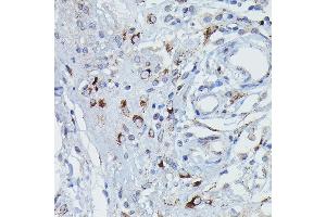 Immunohistochemistry of paraffin-embedded Human pancreatic panniculitis using GSDME Rabbit pAb (ABIN6127757, ABIN6139554, ABIN6139555 and ABIN6223304) at dilution of 1:50 (40x lens). (Non-Syndromic Hearing Impairment Protein 5 (GSDME) (AA 1-260) anticorps)