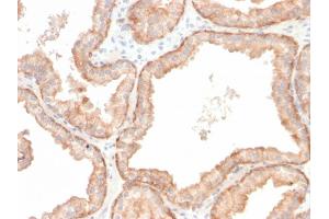 Formalin-fixed, paraffin-embedded human prostate carcinoma stained with Interleukin 10 Recombinant Rabbit Monoclonal Antibody (IL10/2651R). (Recombinant IL-10 anticorps)