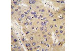 Immunohistochemical staining of formalin-fixed and paraffin-embedded human hepatocarcinoma tissue reacted with ATG12 monoclonal antibody  at 1:50-1:200 dilution. (ATG12 anticorps)