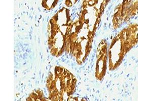 IHC testing of human prostate carcinoma with PSAP antibody (clone PSPN1-1). (Prosaposin anticorps)