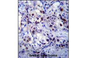RB1 Antibody  (ABIN1881730 and ABIN2840685) immunohistochemistry analysis in formalin fixed and paraffin embedded human breast carcinoma followed by peroxidase conjugation of the secondary antibody and DAB staining. (Retinoblastoma 1 anticorps  (AA 586-615))
