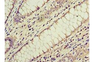 Immunohistochemistry of paraffin-embedded human colon cancer using ABIN7143179 at dilution of 1:100 (ACVR1C/ALK7 anticorps  (AA 22-113))