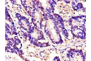 Immunohistochemistry of paraffin-embedded human colon cancer using ABIN7172305 at dilution of 1:100 (TOR1A anticorps  (AA 88-125))